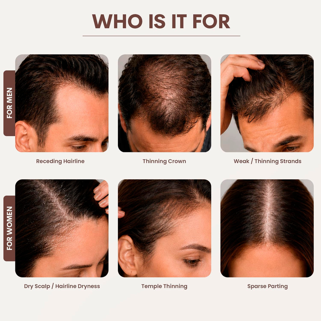 SØREN Micro Infusion Hair Renewal System by SOREN - Saw Palmetto & Peptide Scalp Treatment Kit | Supports Fuller, Thicker-Looking Hair | Gold Microinfuse Applicator (3 Month Supply)
