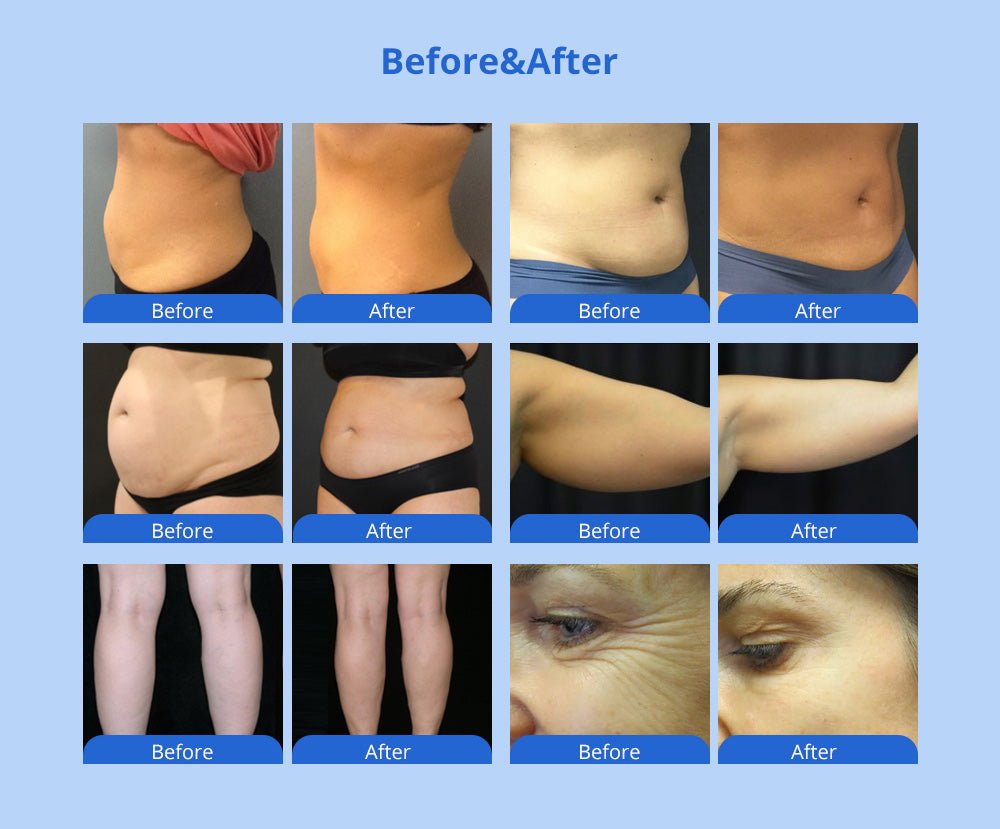 Shape Tactics 5-in-1 Cavitation RF Vacuum LED Laser Body Contouring System