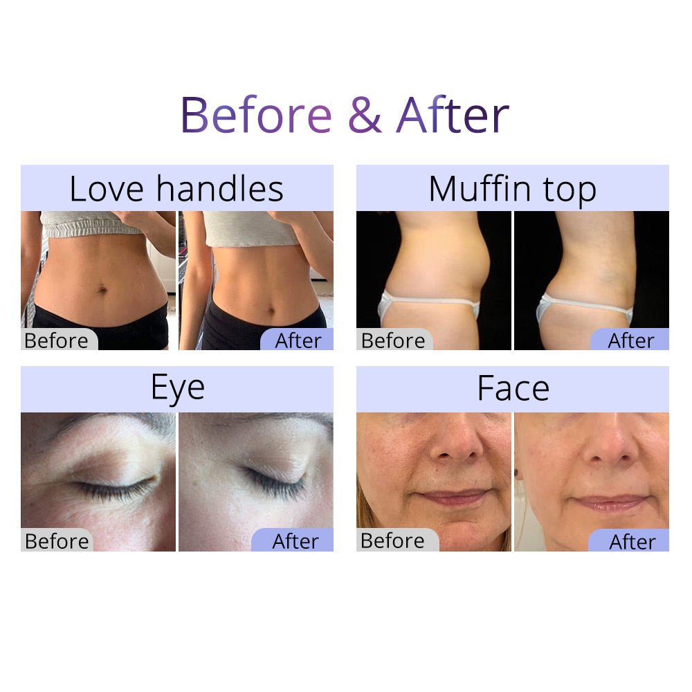 Shape Tactics 9-in-1 Ultrasonic Cavitation RF Lipo Laser Body Contouring System