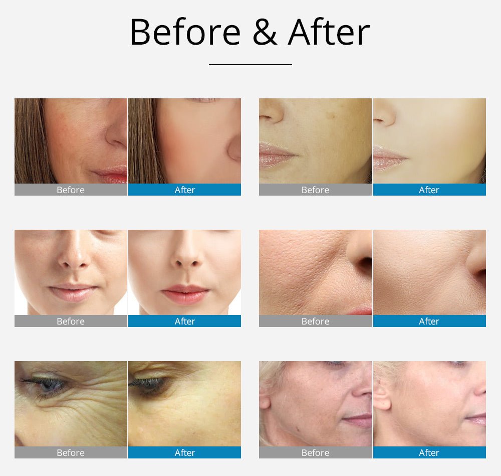Shape Tactics 2-in-1 RF EMS Mesotherapy Skin Rejuvenation System