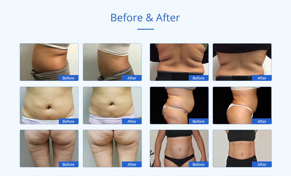 Shape Tactics Advanced 8-in-1 Unoisetion Cavitation & RF System with LED Laser Pads
