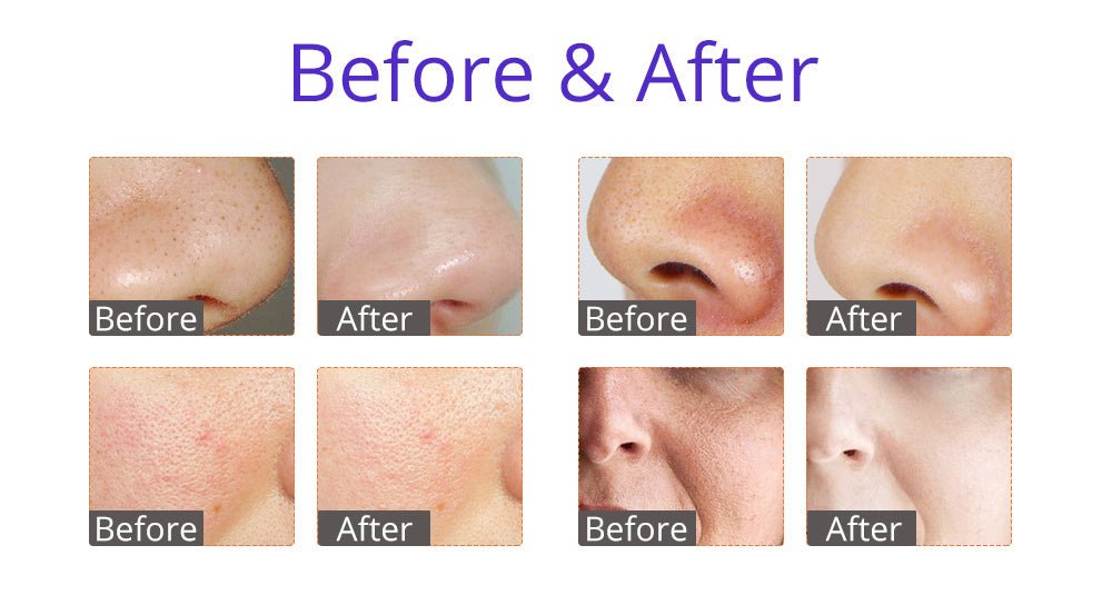 Shape Tactics HydroGlow Pro 6-in-1 Facial Rejuvenation System