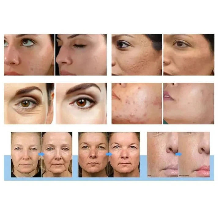 Shape Tactics Morpheus 3-in-1 Gold RF & Cold Therapy System