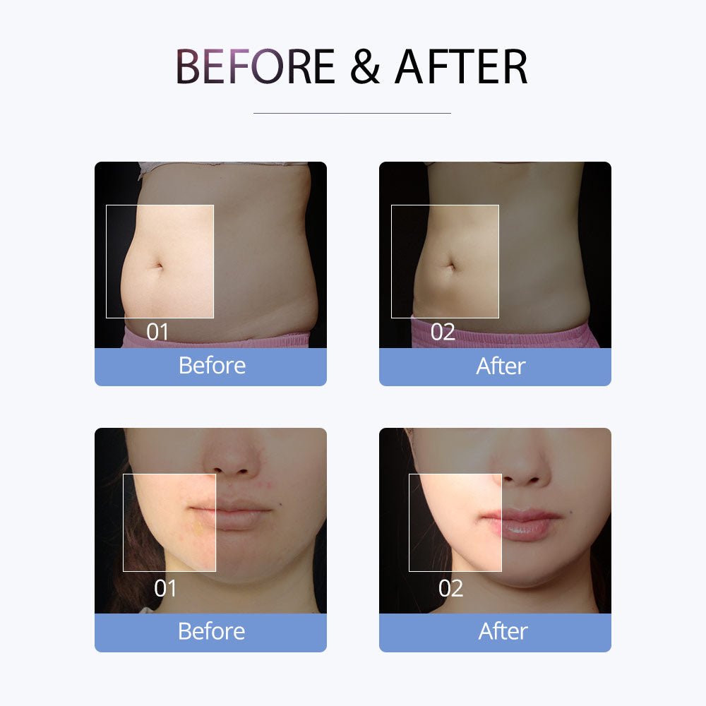 Shape Tactics S-Shape Cavitation RF Electroporation Vacuum System